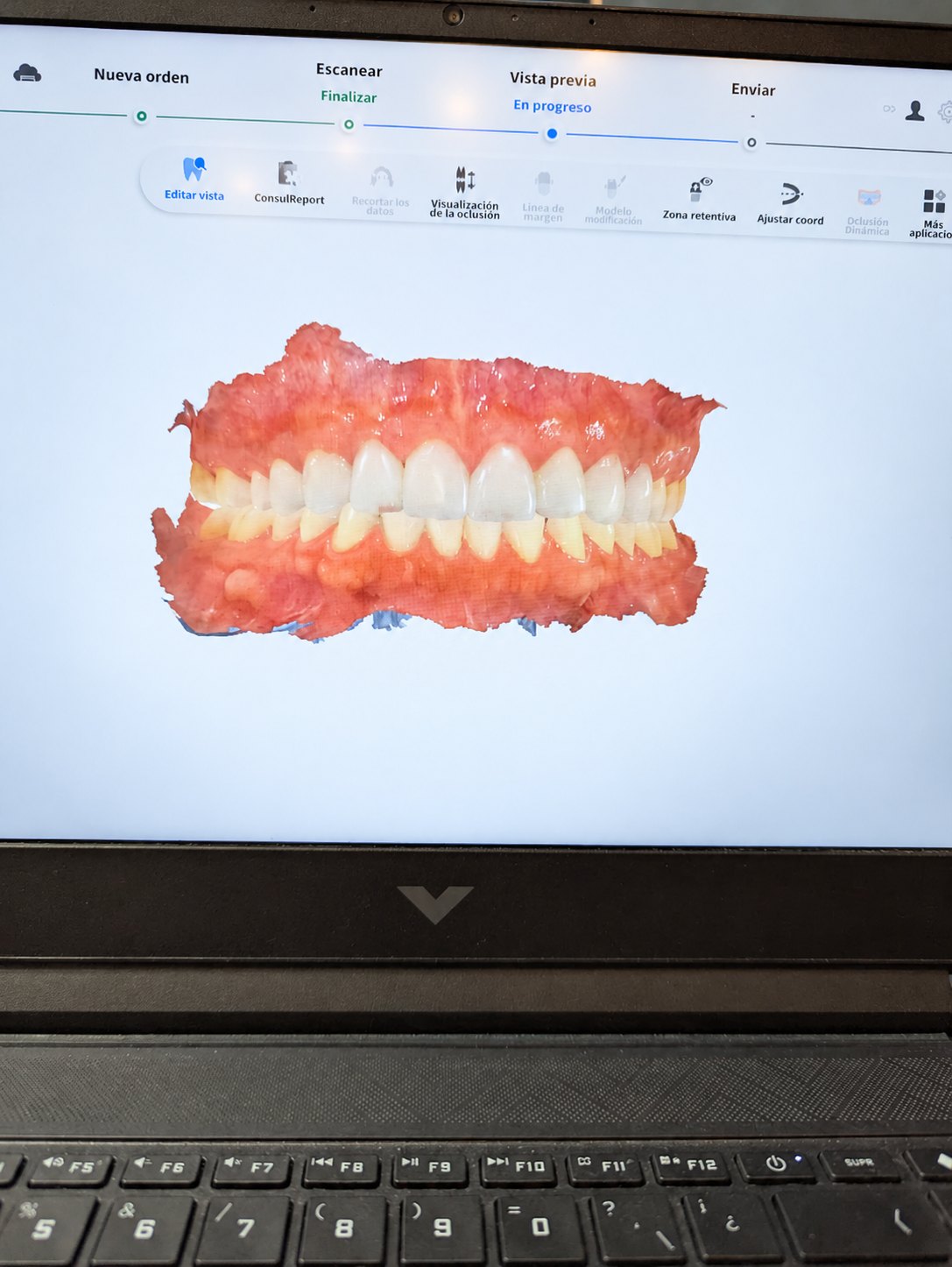 Escaneo intraoral digital de una sonrisa en la pantalla de una laptop